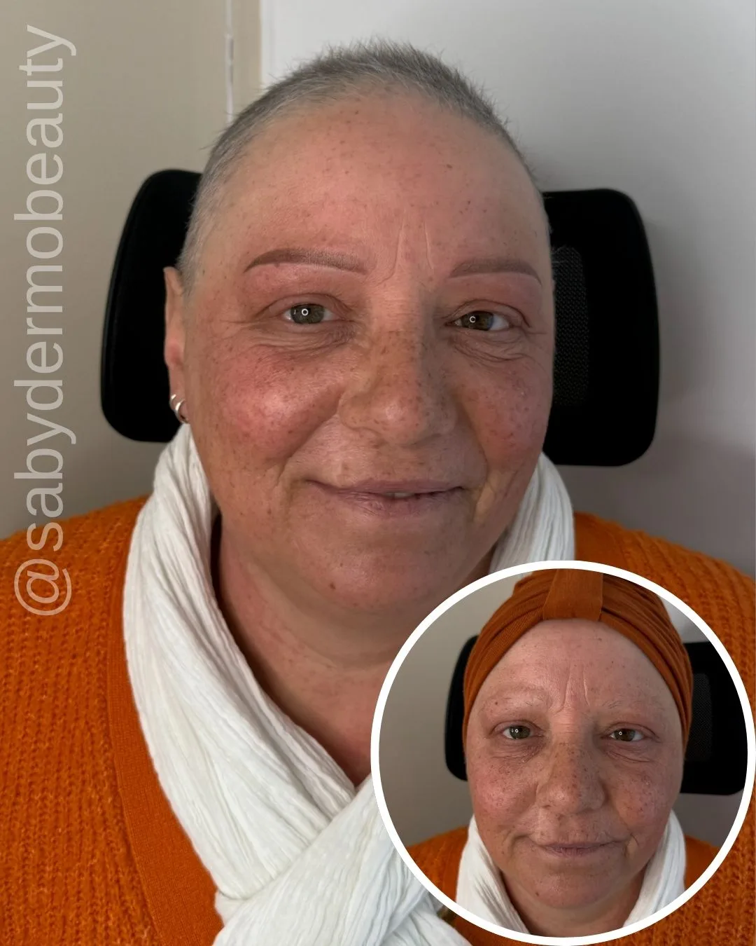 Sourcils après chimiothérapie - Dermopigmentation réparatrice Vendée - SabyDermoBeauty